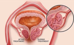 Illustration of a prostate during and after prostate artery embolization treatment by KCUC