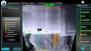 Aquablation Therapy Step 1 - KCUC Sept Urology Awareness Month 2025
