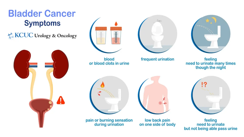 Bladder Cancer Common Symptoms KCUC